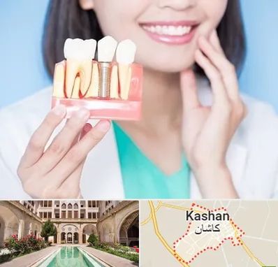متخصص ایمپلنت در کاشان