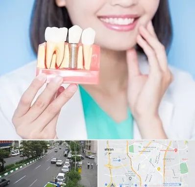 متخصص ایمپلنت در ستارخان