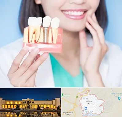 متخصص ایمپلنت در برازجان