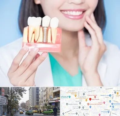 متخصص ایمپلنت در فاطمی