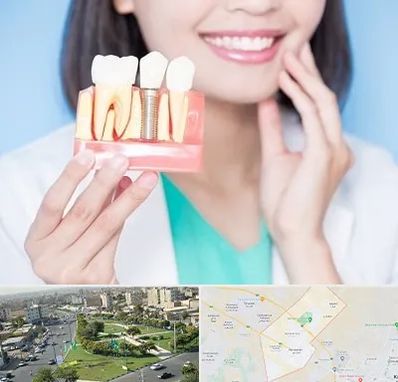 متخصص ایمپلنت در کمال شهر کرج