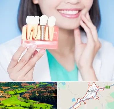 متخصص ایمپلنت در نکا