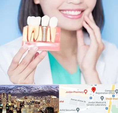 متخصص ایمپلنت در جردن