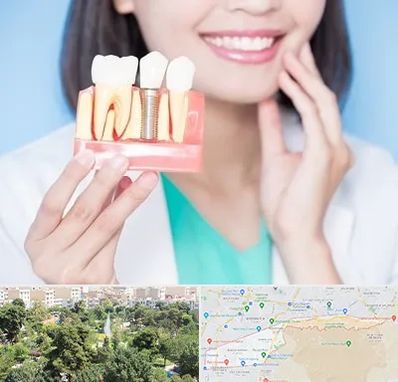 متخصص ایمپلنت در منطقه 13 تهران