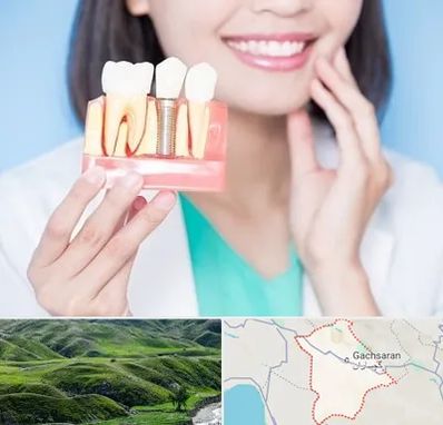 متخصص ایمپلنت در گچساران