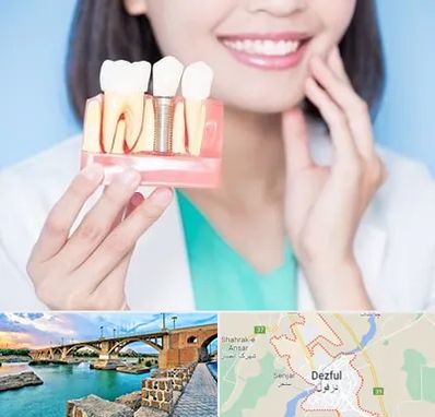 متخصص ایمپلنت در دزفول