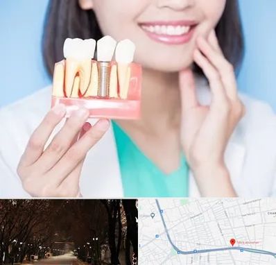 متخصص ایمپلنت در ابوریحان تبریز