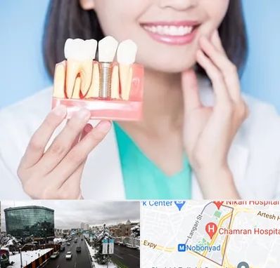 متخصص ایمپلنت در اقدسیه