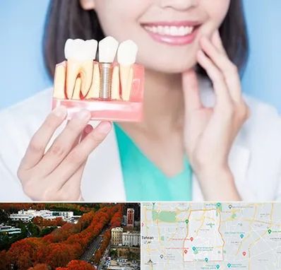 متخصص ایمپلنت در منطقه 6 تهران