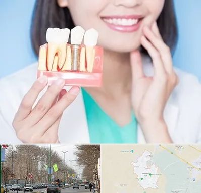 متخصص ایمپلنت در نظرآباد کرج