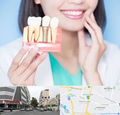 متخصص ایمپلنت در بلوار فردوس