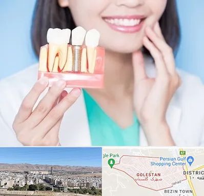 متخصص ایمپلنت در شهرک گلستان شیراز
