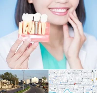 متخصص ایمپلنت در ضیابری رشت