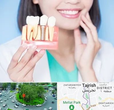 متخصص ایمپلنت در تجریش