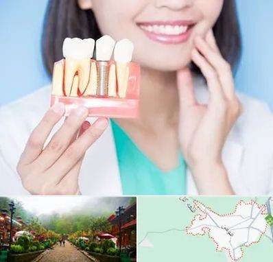 متخصص ایمپلنت در فومن