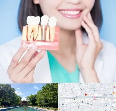 متخصص ایمپلنت در هشت بهشت اصفهان