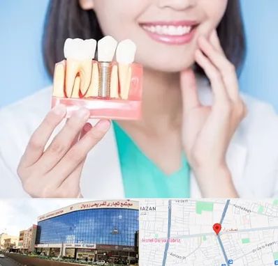 متخصص ایمپلنت در نصف راه تبریز