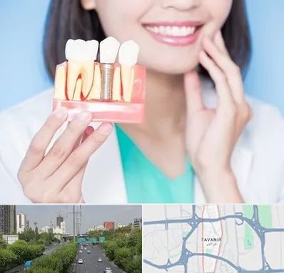 متخصص ایمپلنت در توانیر