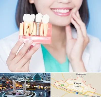 متخصص ایمپلنت در زنجان