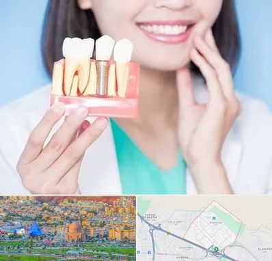 متخصص ایمپلنت در رشدیه تبریز