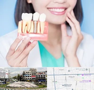 متخصص ایمپلنت در مرکز تهران