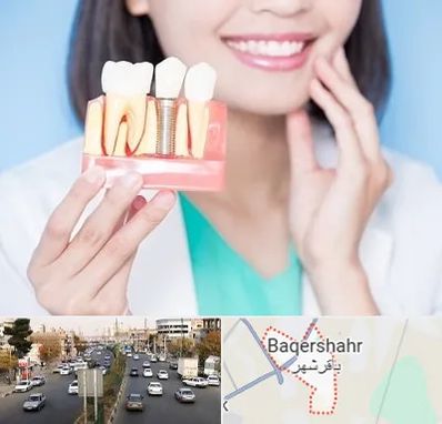 متخصص ایمپلنت در باقرشهر