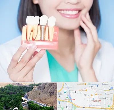 متخصص ایمپلنت در کن