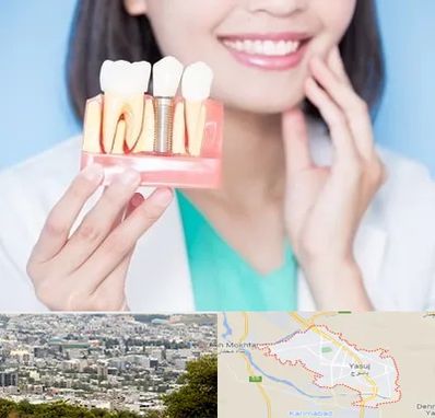 متخصص ایمپلنت در یاسوج