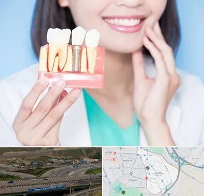 متخصص ایمپلنت در یاغچیان تبریز