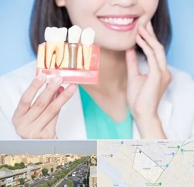 متخصص ایمپلنت در کیانمهر کرج