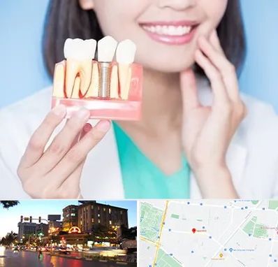 متخصص ایمپلنت در بلوار سجاد مشهد