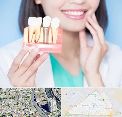 متخصص ایمپلنت در قاسم آباد مشهد