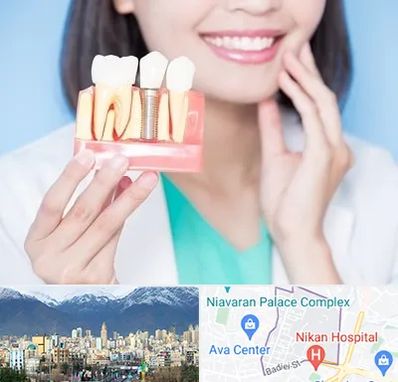 متخصص ایمپلنت در آجودانیه