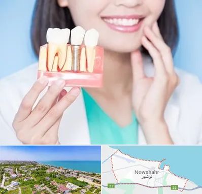 متخصص ایمپلنت در نوشهر