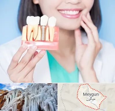 متخصص ایمپلنت در میگون