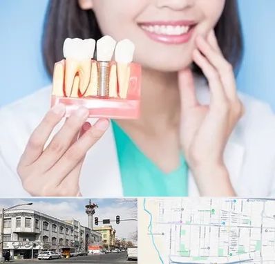 متخصص ایمپلنت در 17شهریور