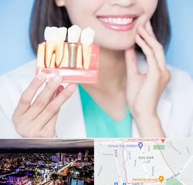 متخصص ایمپلنت در گلسار رشت