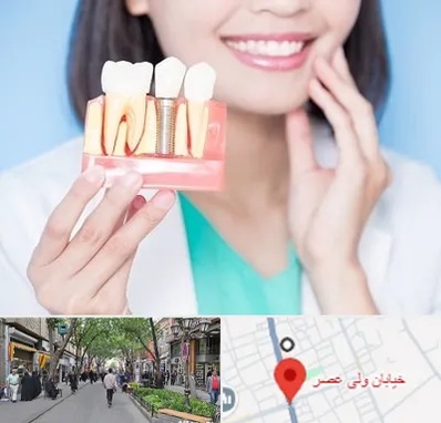 متخصص ایمپلنت در ولیعصر شهریار