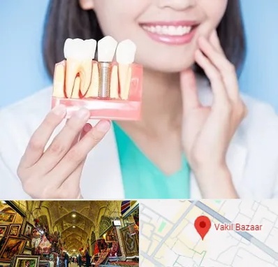 متخصص ایمپلنت در بازار وکیل شیراز