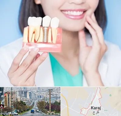 متخصص ایمپلنت در گوهردشت