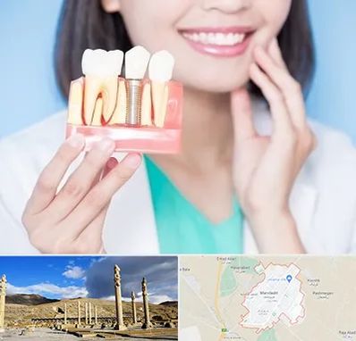 متخصص ایمپلنت در مرودشت