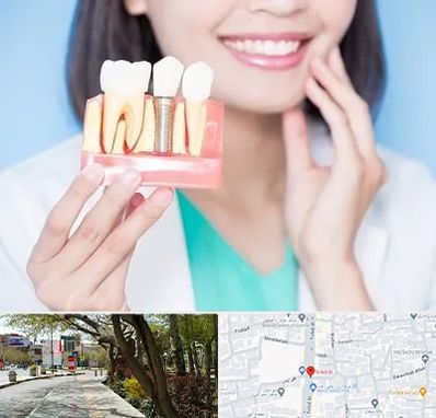 متخصص ایمپلنت در خیابان توحید اصفهان