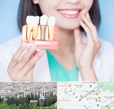متخصص ایمپلنت در محلاتی شیراز