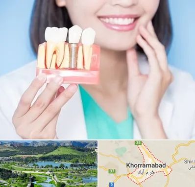 متخصص ایمپلنت در خرم آباد