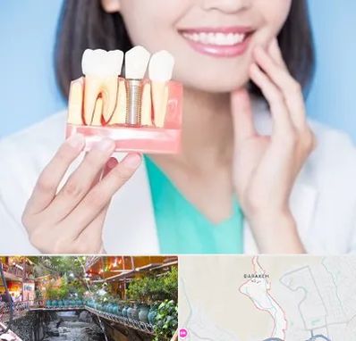 متخصص ایمپلنت در درکه