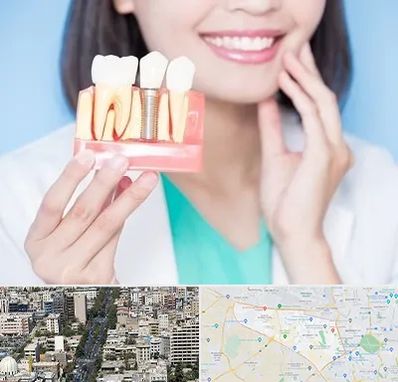 متخصص ایمپلنت در منطقه 18 تهران