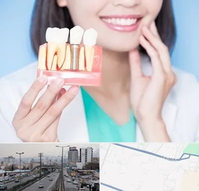 متخصص ایمپلنت در بلوار ارتش