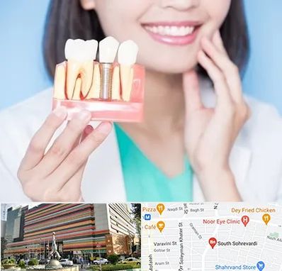 متخصص ایمپلنت در سهروردی