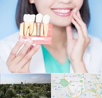 متخصص ایمپلنت در منطقه 16 تهران