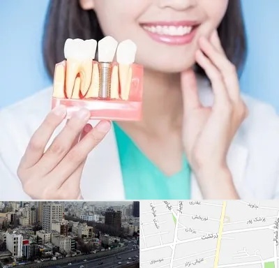 متخصص ایمپلنت در زرتشت